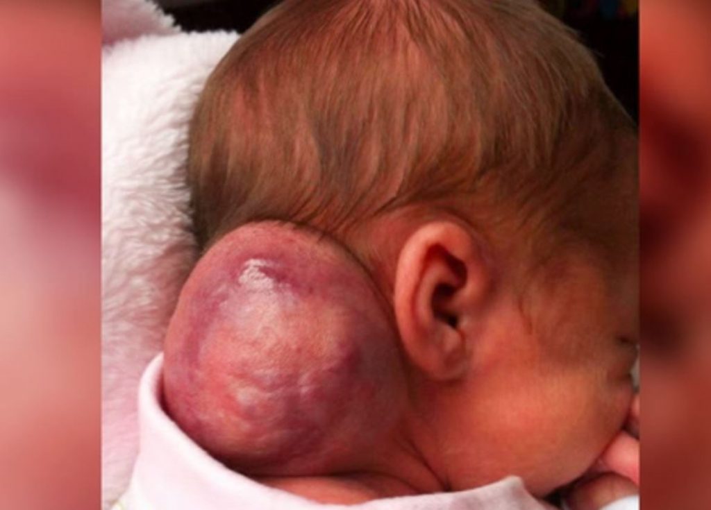 Albtraum: Dieses Baby trägt eine Beule so groß wie der eigene Kopf am Hals