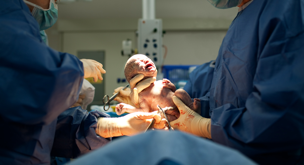 “Gentle” C-Section: Diese Kaiserschnitt-Methode ist eine Bereicherung für Mamas und Babys