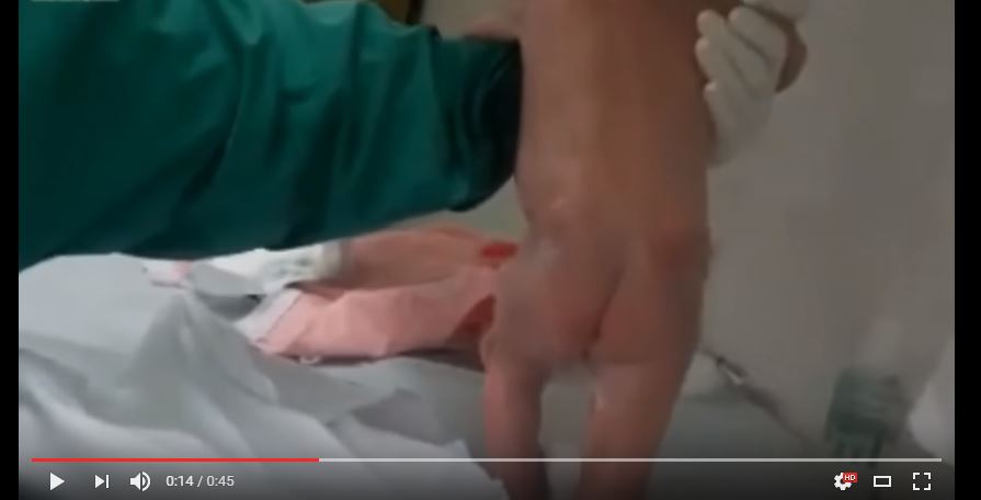 Video: Dieses Baby macht direkt nach der Geburt seine ersten Schritte