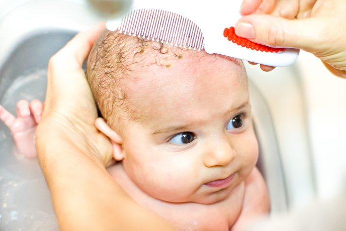 Baby: Was tun bei gelblichen Schuppen auf der Kopfhaut?