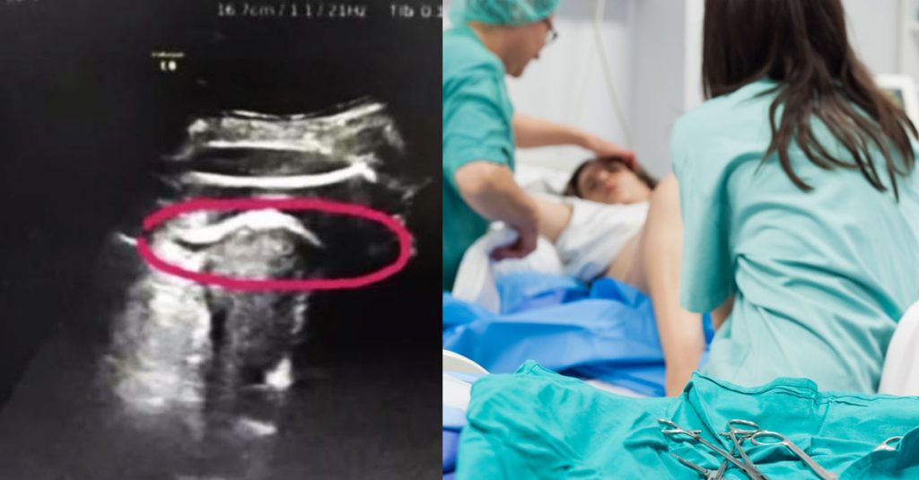 Schock: Ungeborenes riss Loch in die Gebärmutter