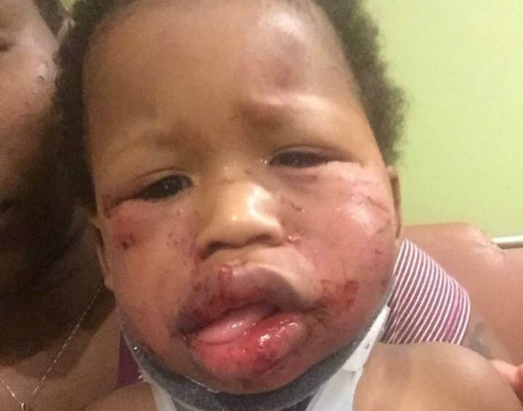 Dieser Einjährige wurde in den Krippe brutal geschlagen
