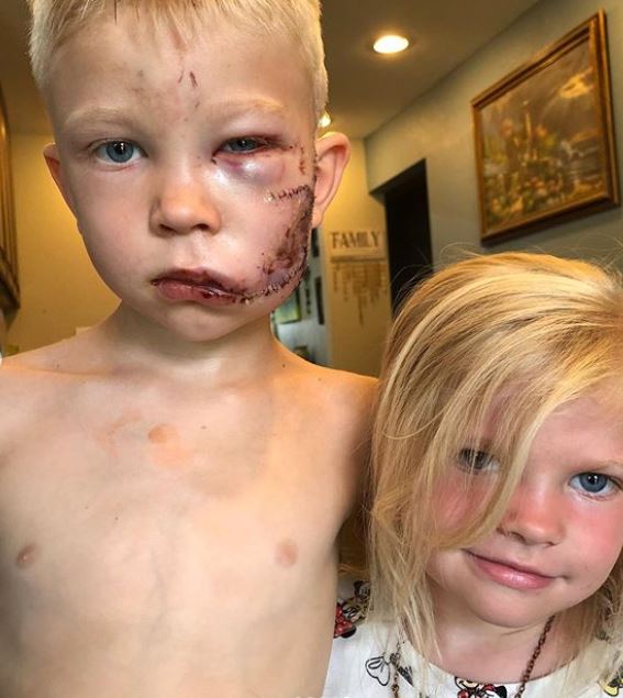 6-Jähriger schützt Schwester vor Hundeangriff und wird gebissen